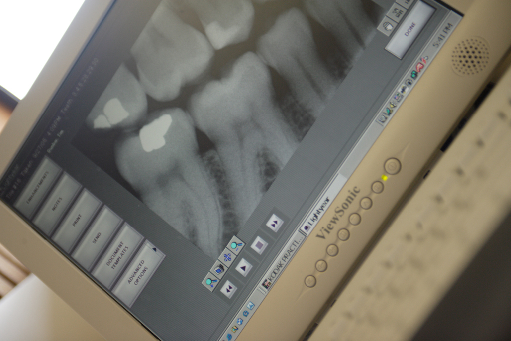 Low radiation digital X-rays 